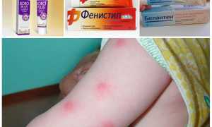 Что делать, если ребенка кусают блохи, фото укусов