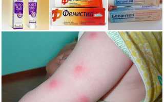 Что делать, если ребенка кусают блохи, фото укусов