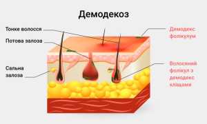 Подкожный клещ у человека — описание и причины появления