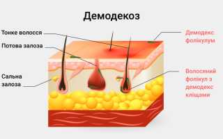 Подкожный клещ у человека — описание и причины появления