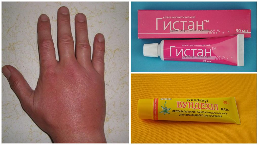 Гомеопатические препараты, применяемые после укуса комара