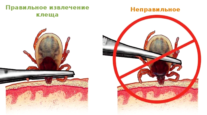 Чем опасен укус клеща: медики предупреждают