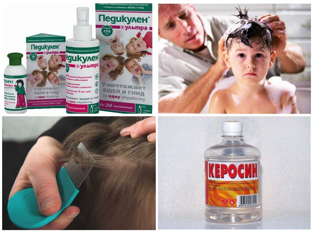 Лечение педикулеза