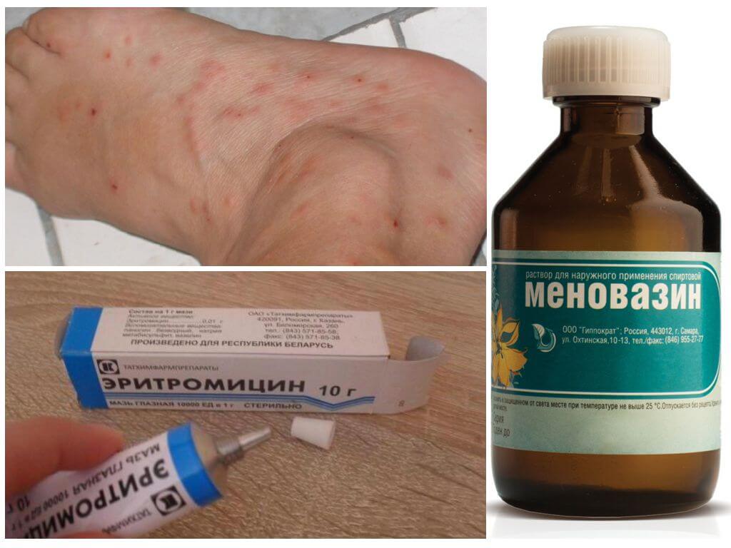Средства от укусов насекомых